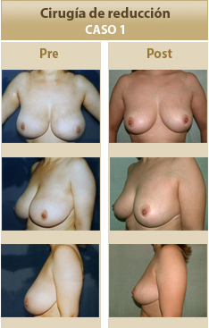 Cirugia mamaria