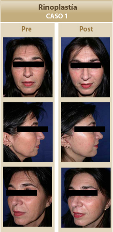 Rinoplastia